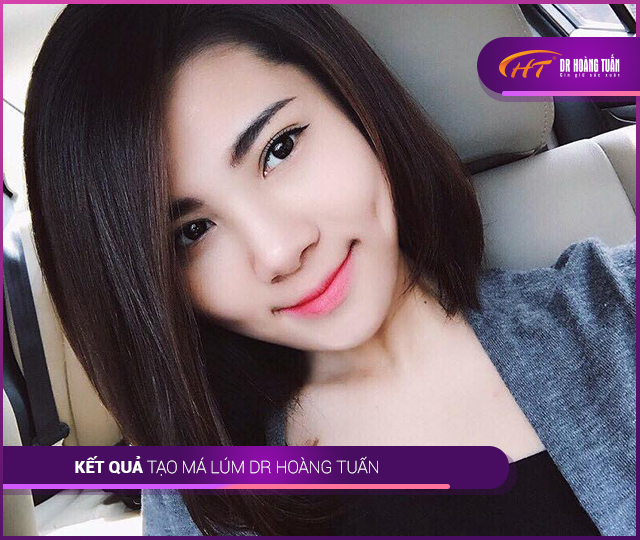 Kết quả tạo má lúm Thẩm mỹ Hoàng Tuấn